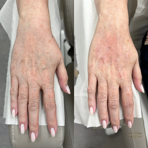 results-longevity-and-recovery-hand-filler