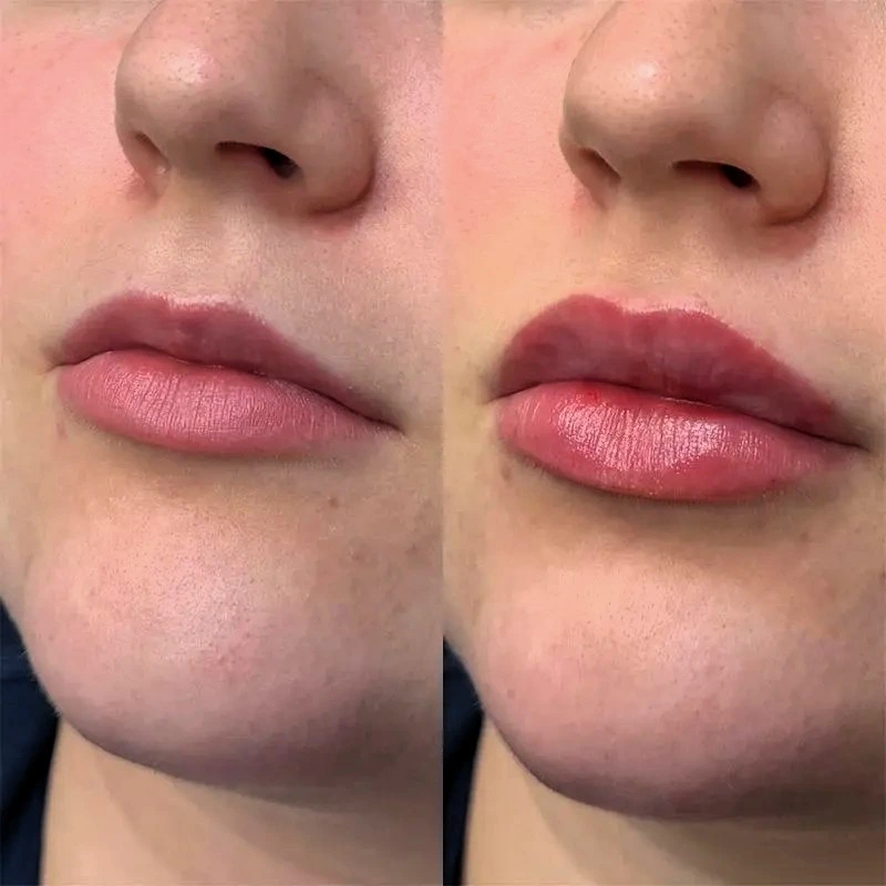 thin-lip-filler-results