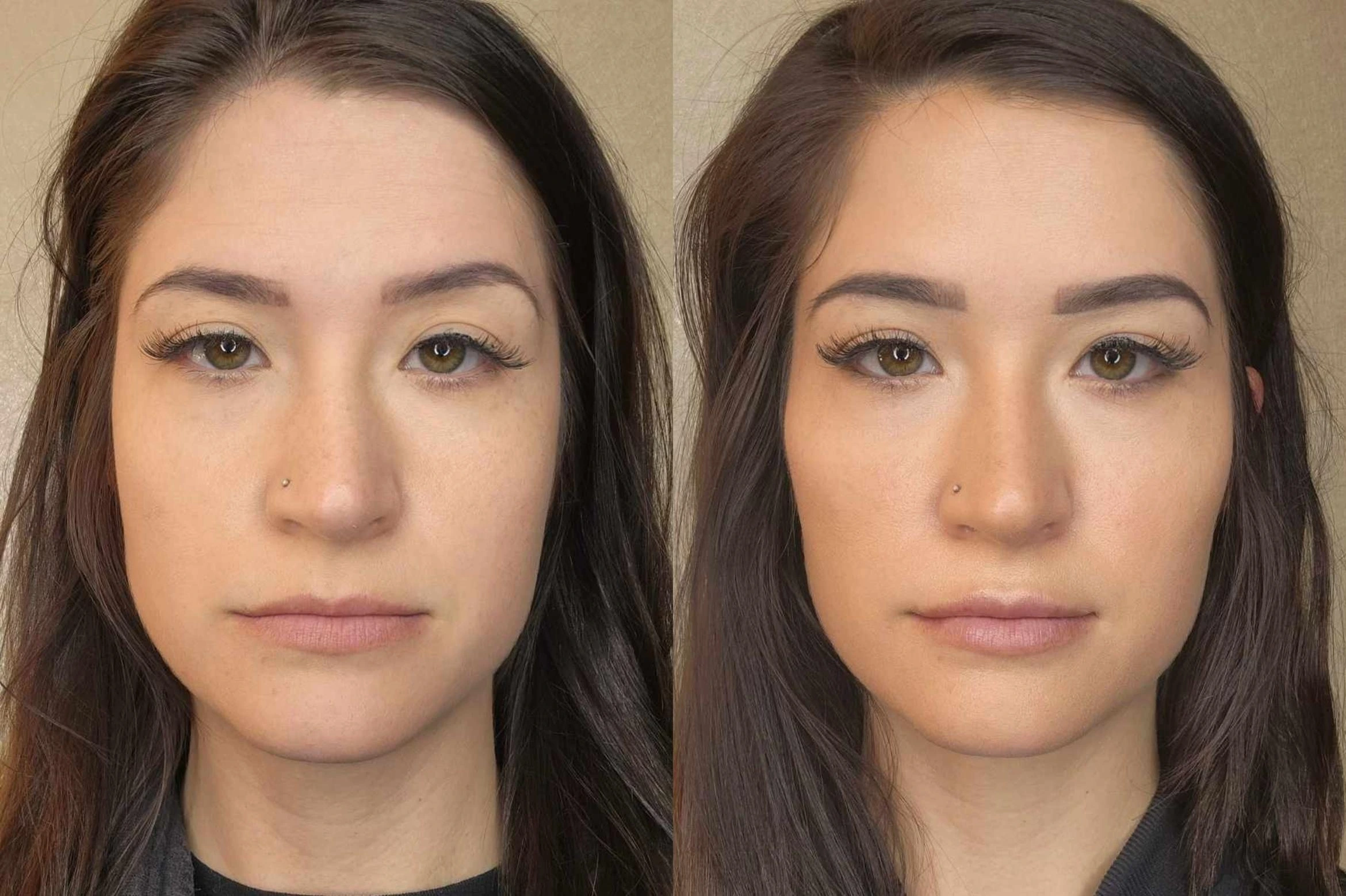 Thin Lip Filler Treatment in London