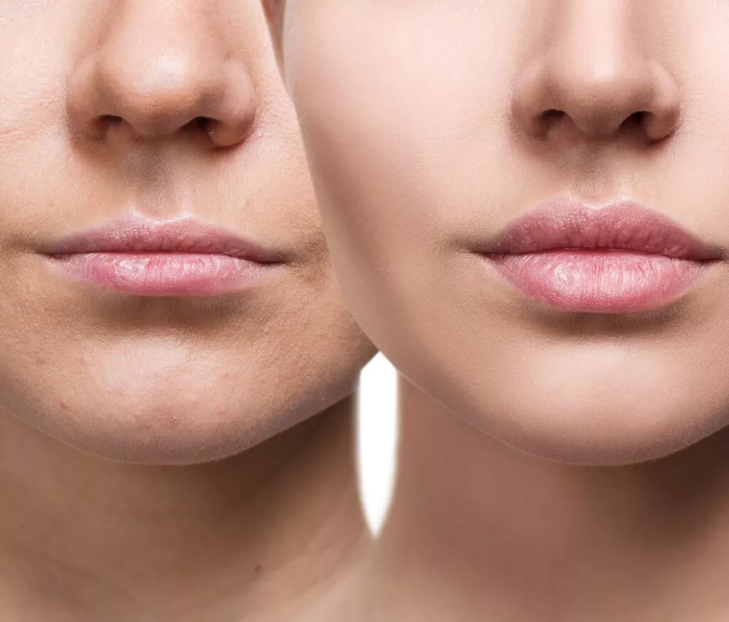 what-thin-lip-filler-treatment-