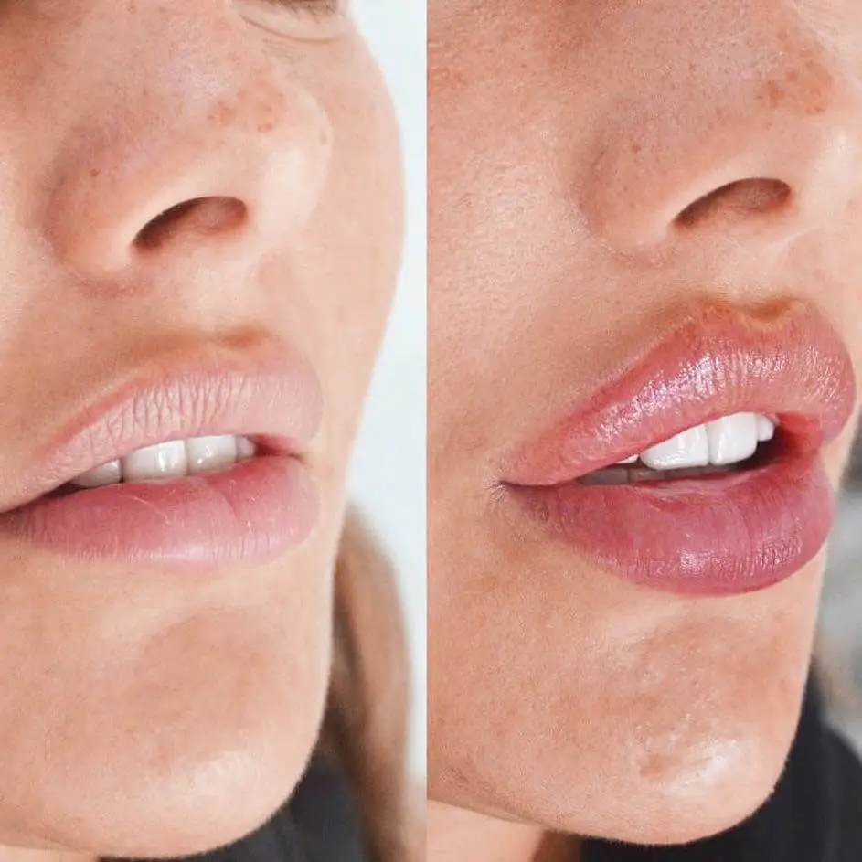 why-choose-london-aesthetics-cupids-bow-lip-filler