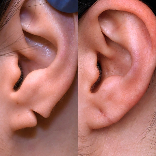 why-choose-london-aesthetics-earlobe-filler