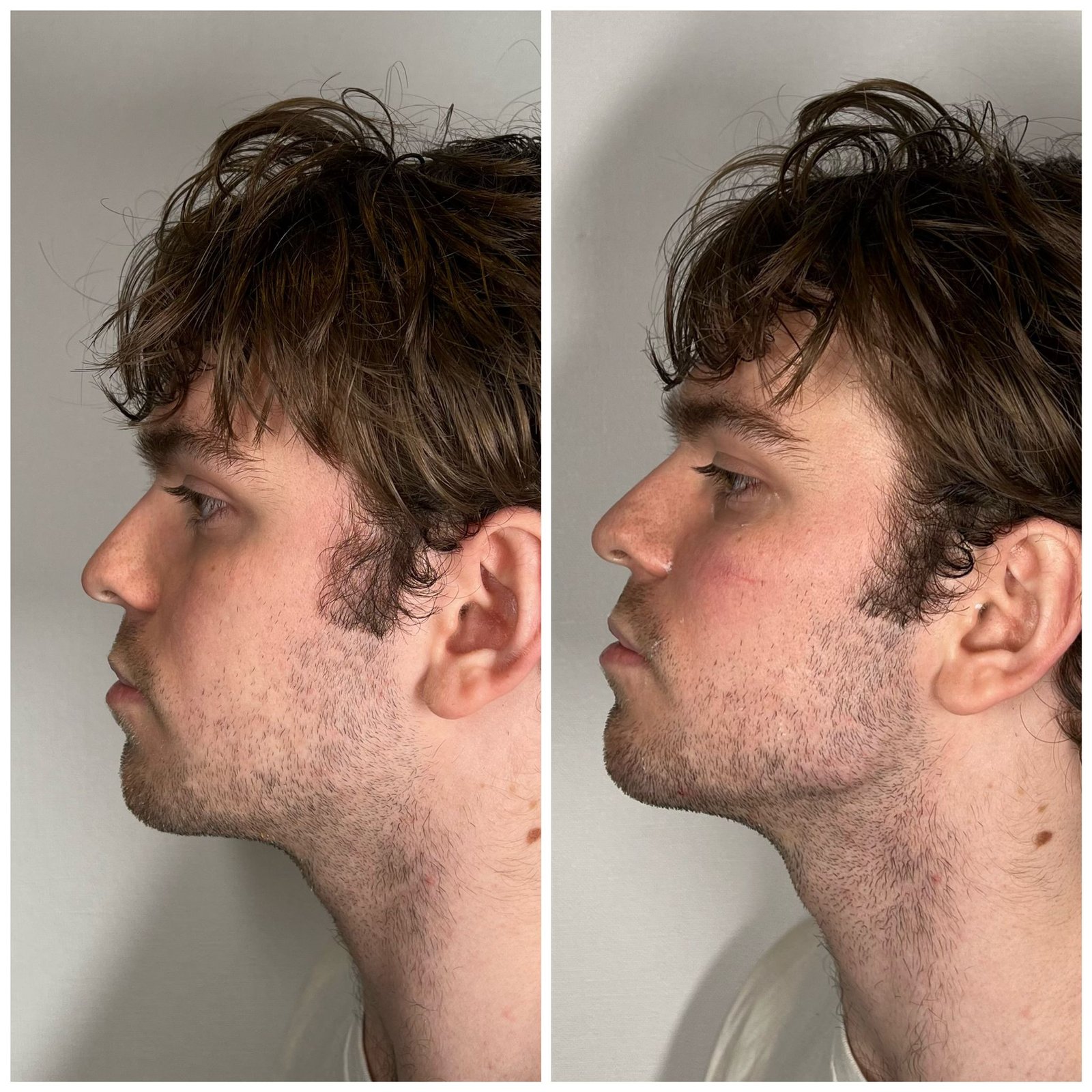 why-choose-london-aesthetics-jowl-filler