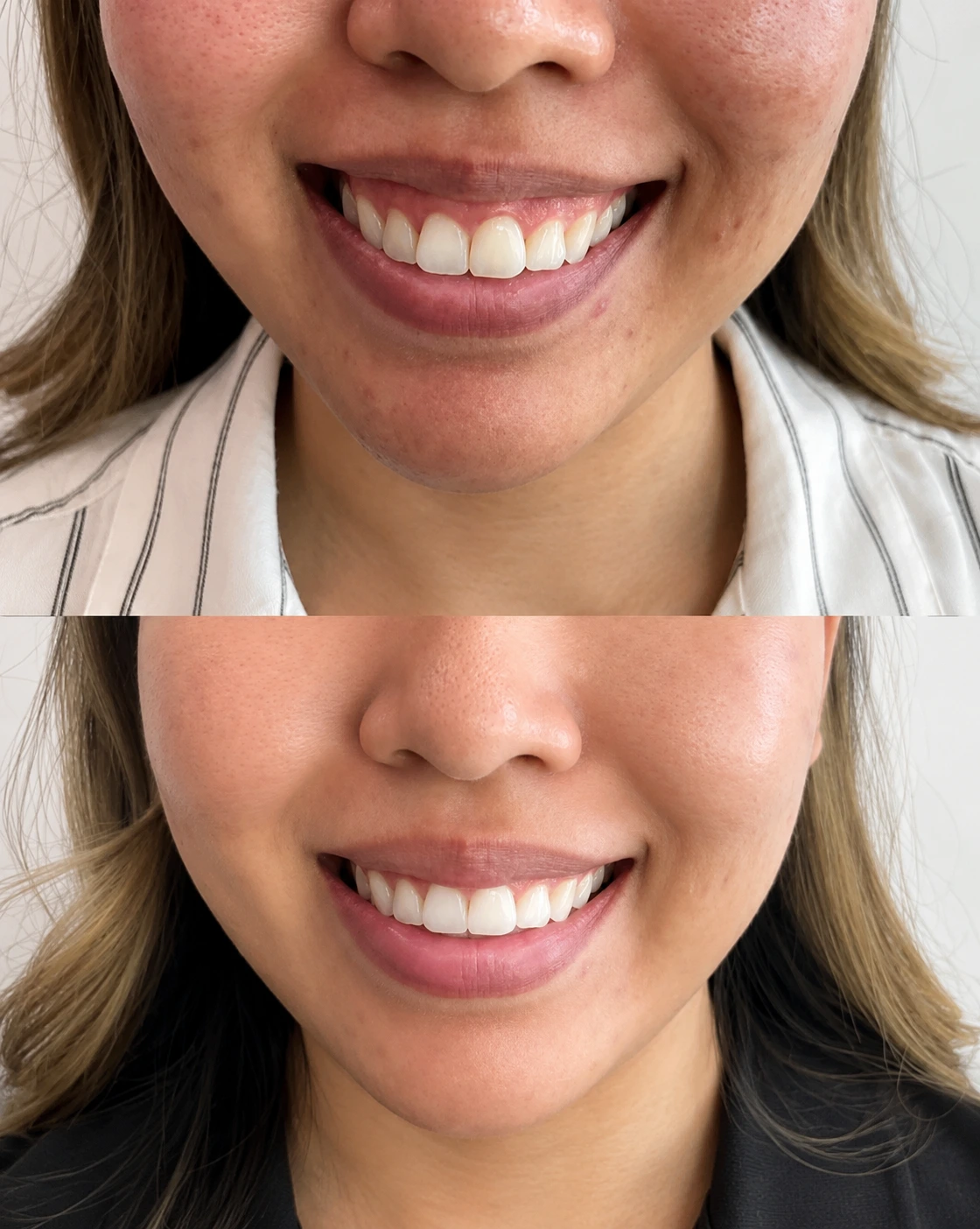 why-choose-london-aesthetics-subtle-lip-filler