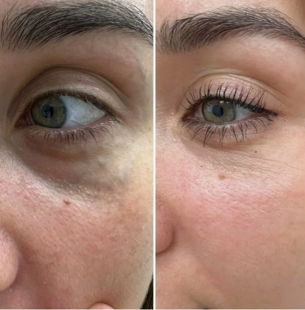 Before-and-After-Nucleofill-Eyes