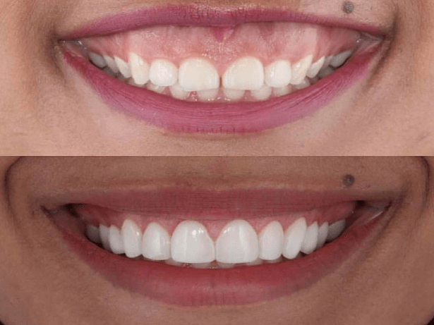 Gummy-Smile_Results