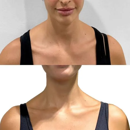 addressing-broad-shoulder-line-and-trapezius-bulk