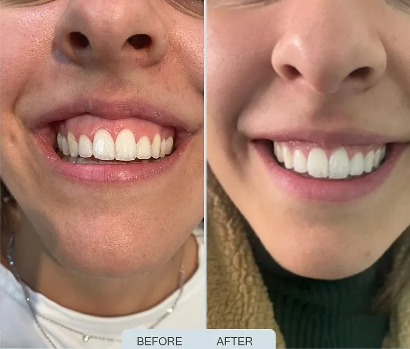 after-gummy-smile-botox