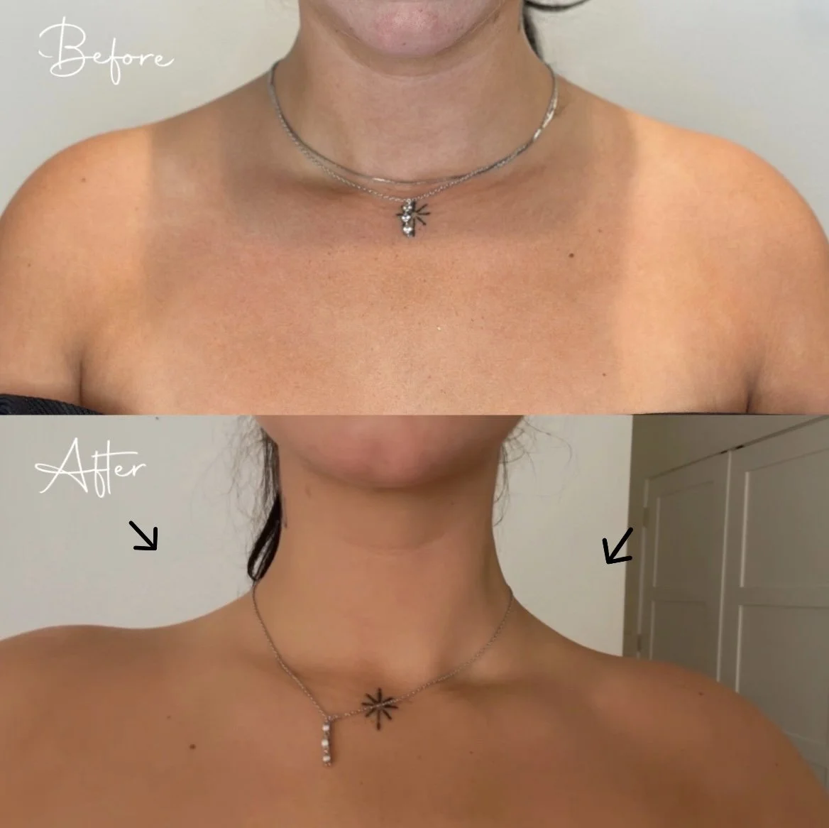 before-and-after-barbie-botox