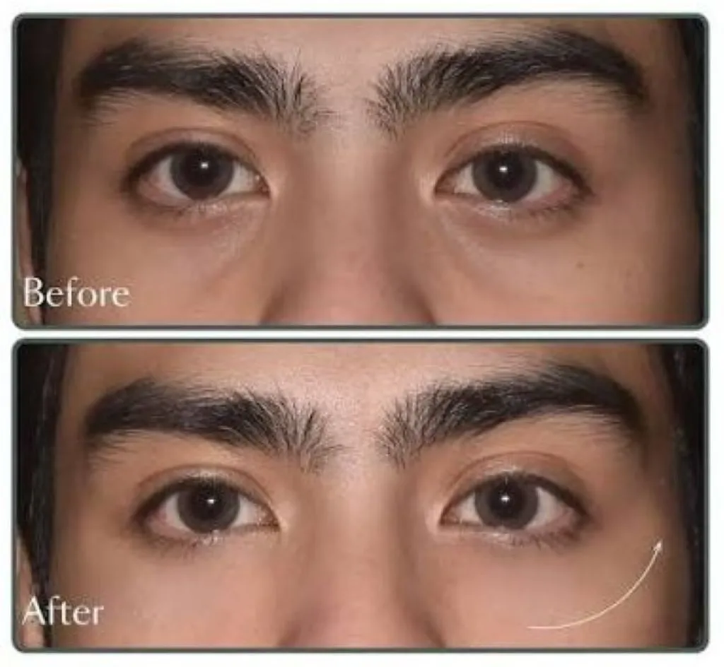 before-and-after-juvelook-under-eyes