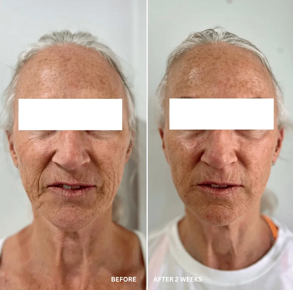 before-and-after-radiesse-treatment