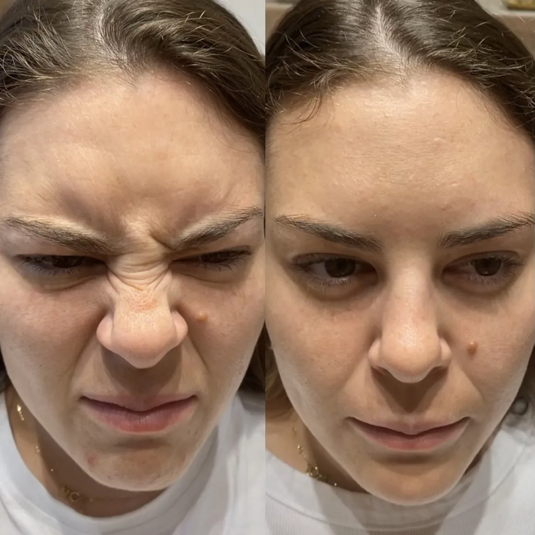 Before and After Bunny Lines Botox