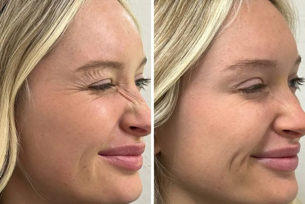 Bunny Lines Botox in London