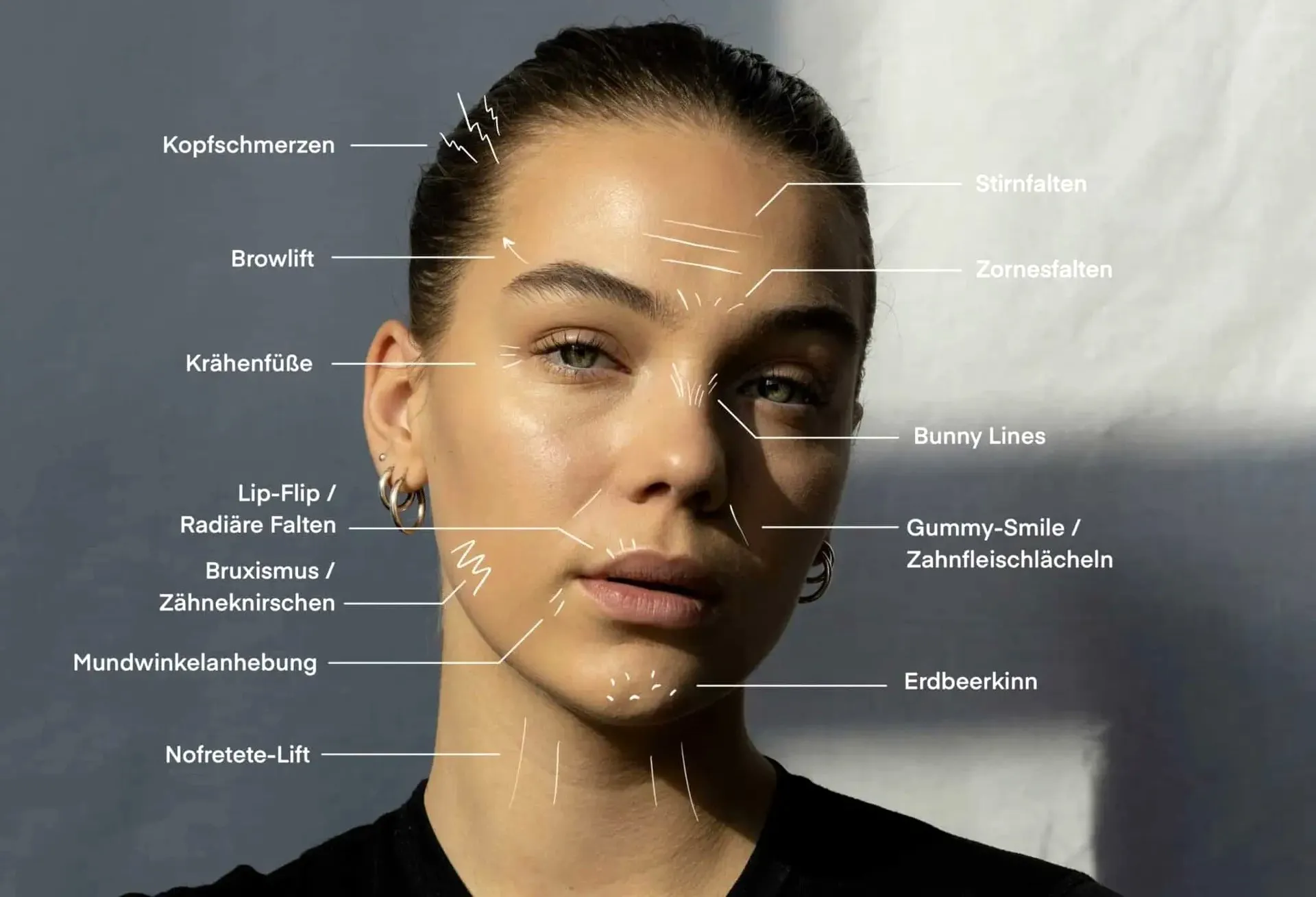 What Is Bunny Lines Botox