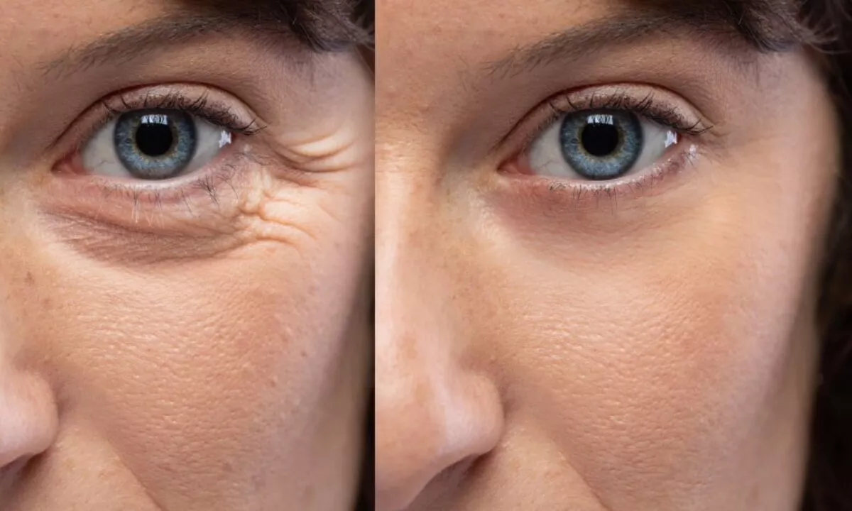 Crow's Feet Botox in London