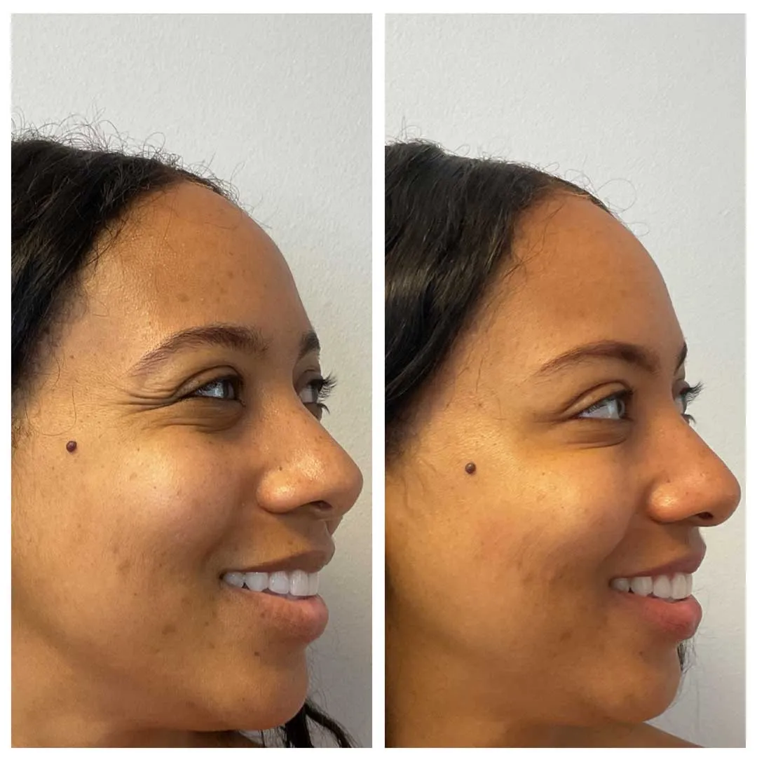 crows-feet-botox-results