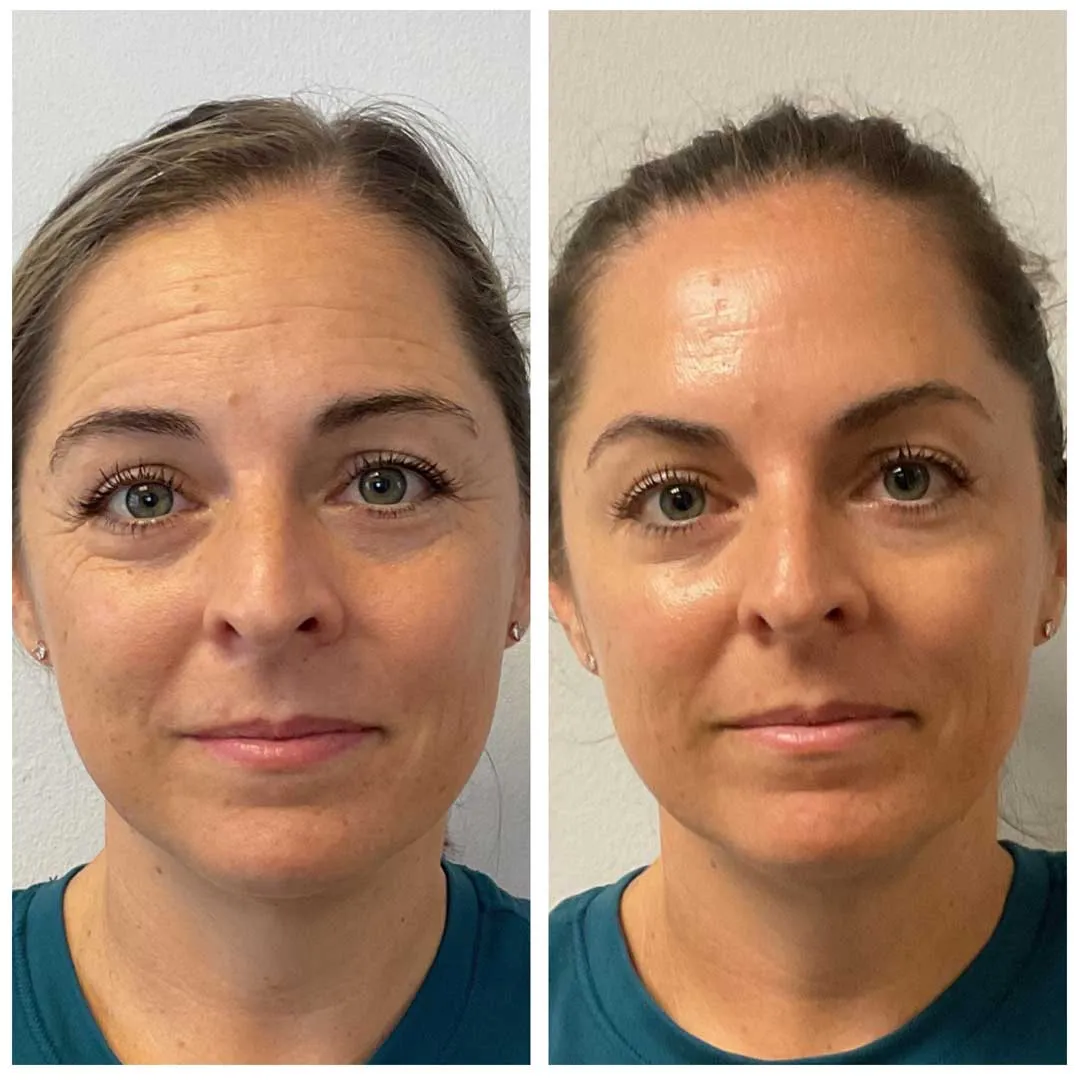 crows-feet-botox-who-treatment-may-suit
