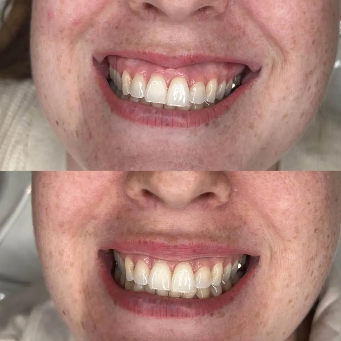 gummy-smile-Consultation