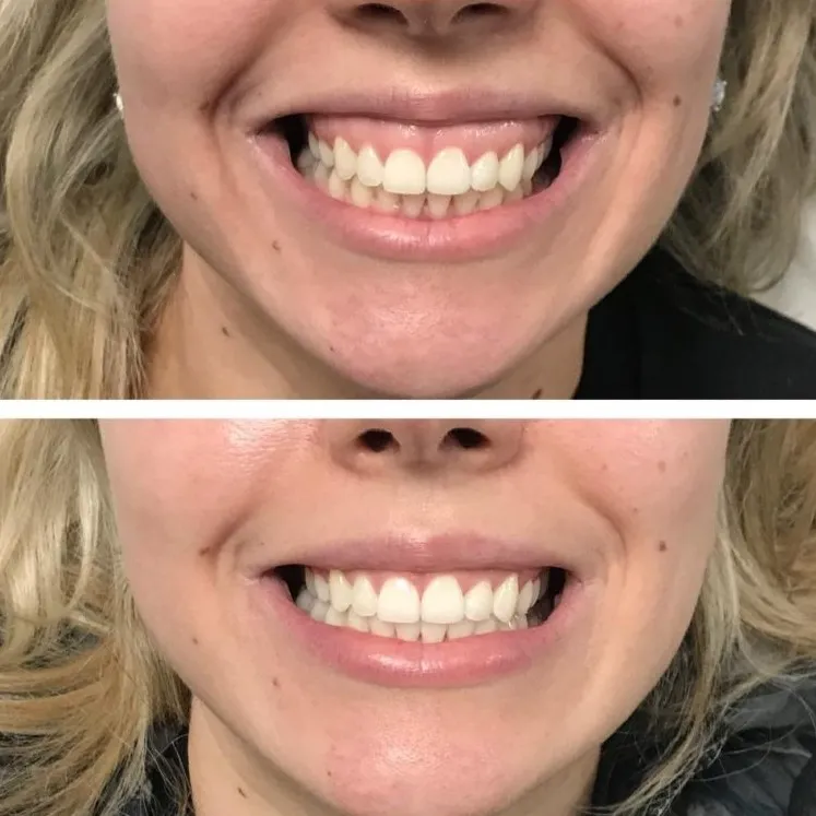 gummy-smile-botox-who-treatment