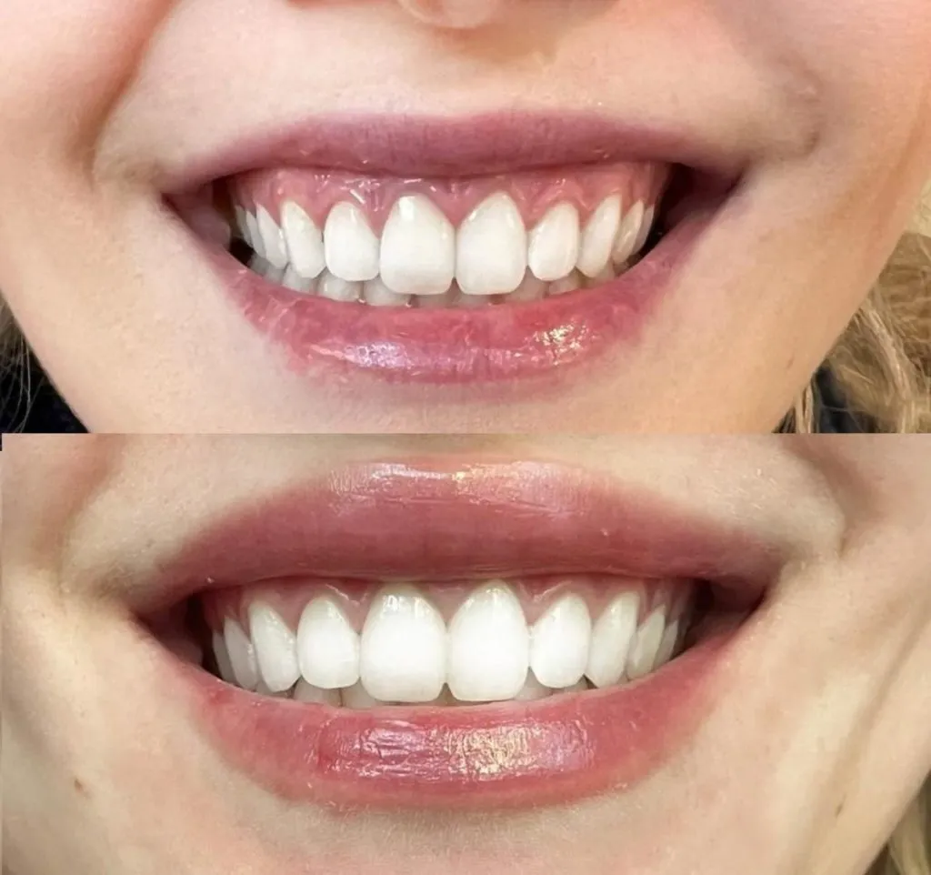 lip-flip-before-and-after