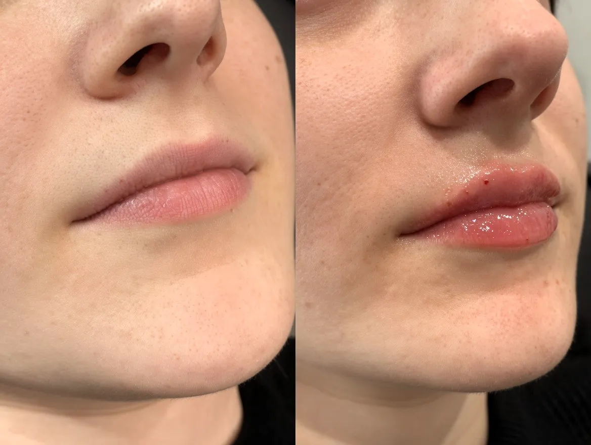 Lip Flip Botox in London