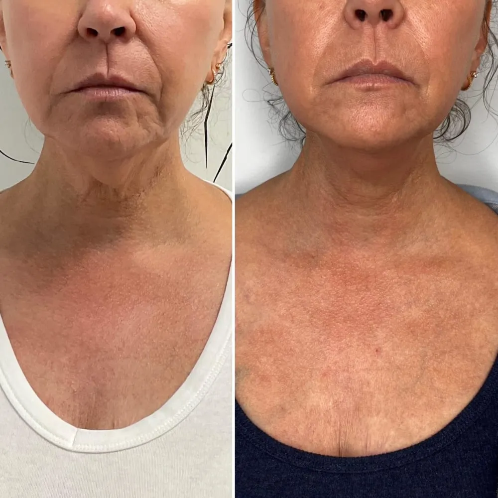 restoring-facial-contour-and-supporting-skin-quality