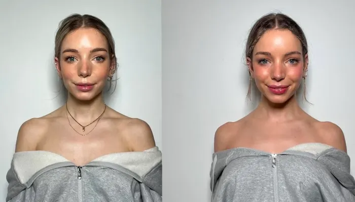 results-barbie-botox