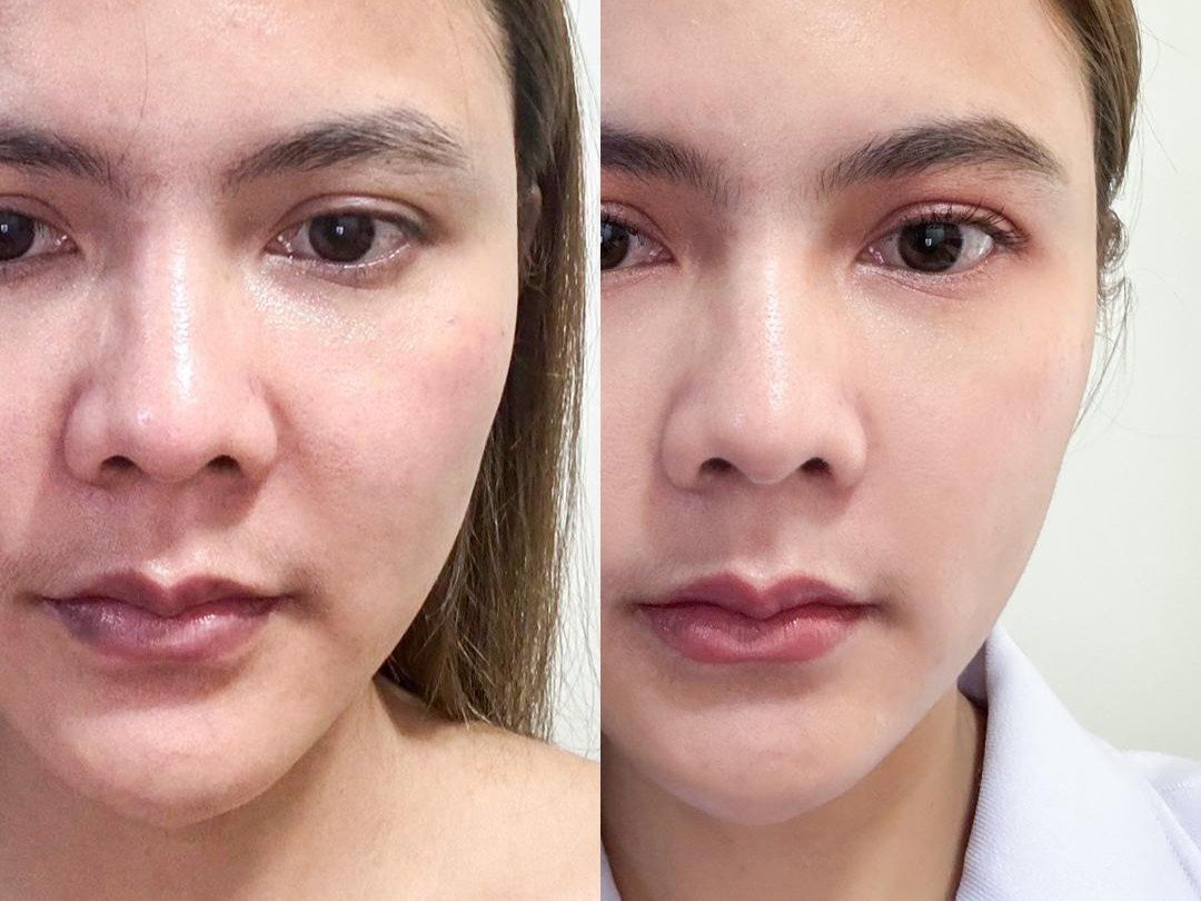 results-juvelook-under-eyes