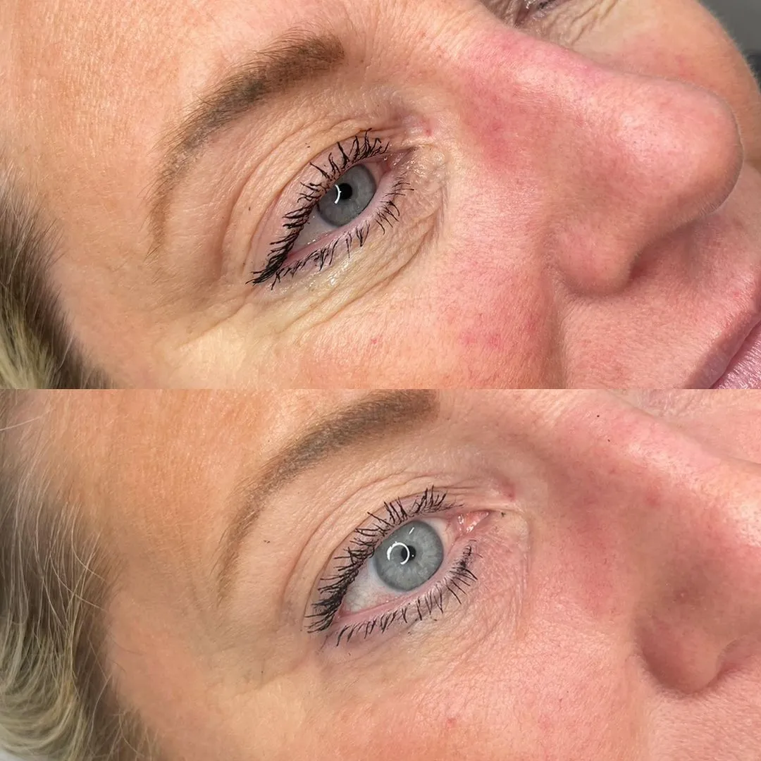 results-nucleofill-eye-treatment