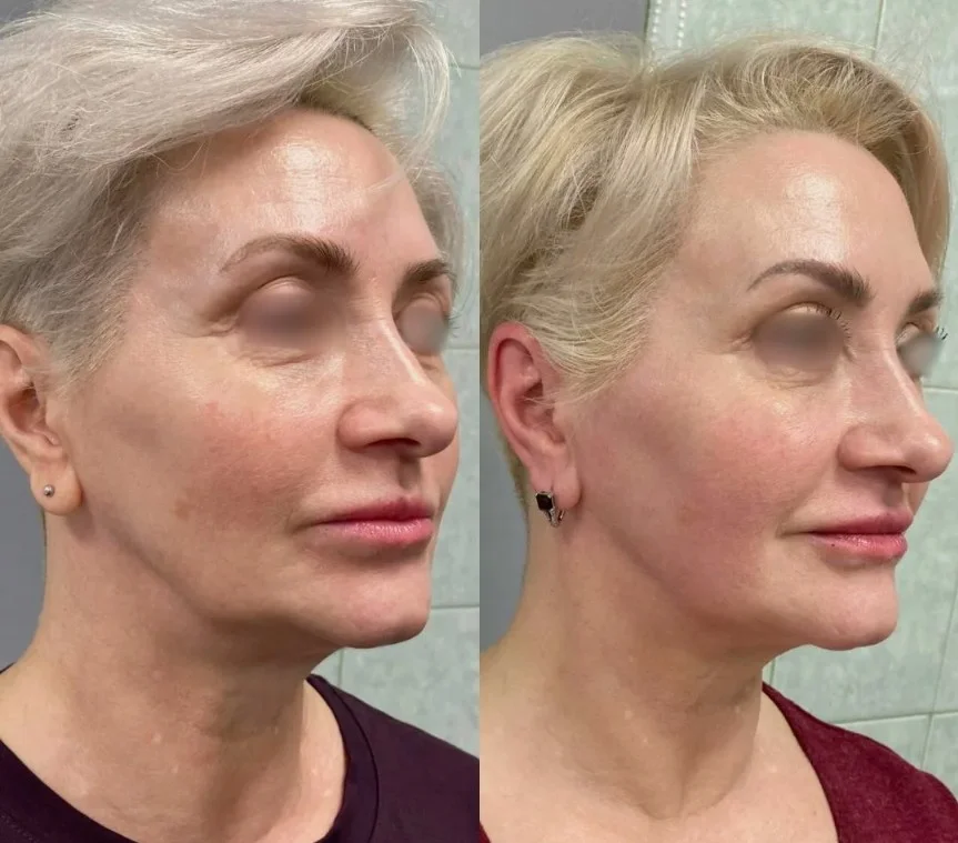 results-sculptra