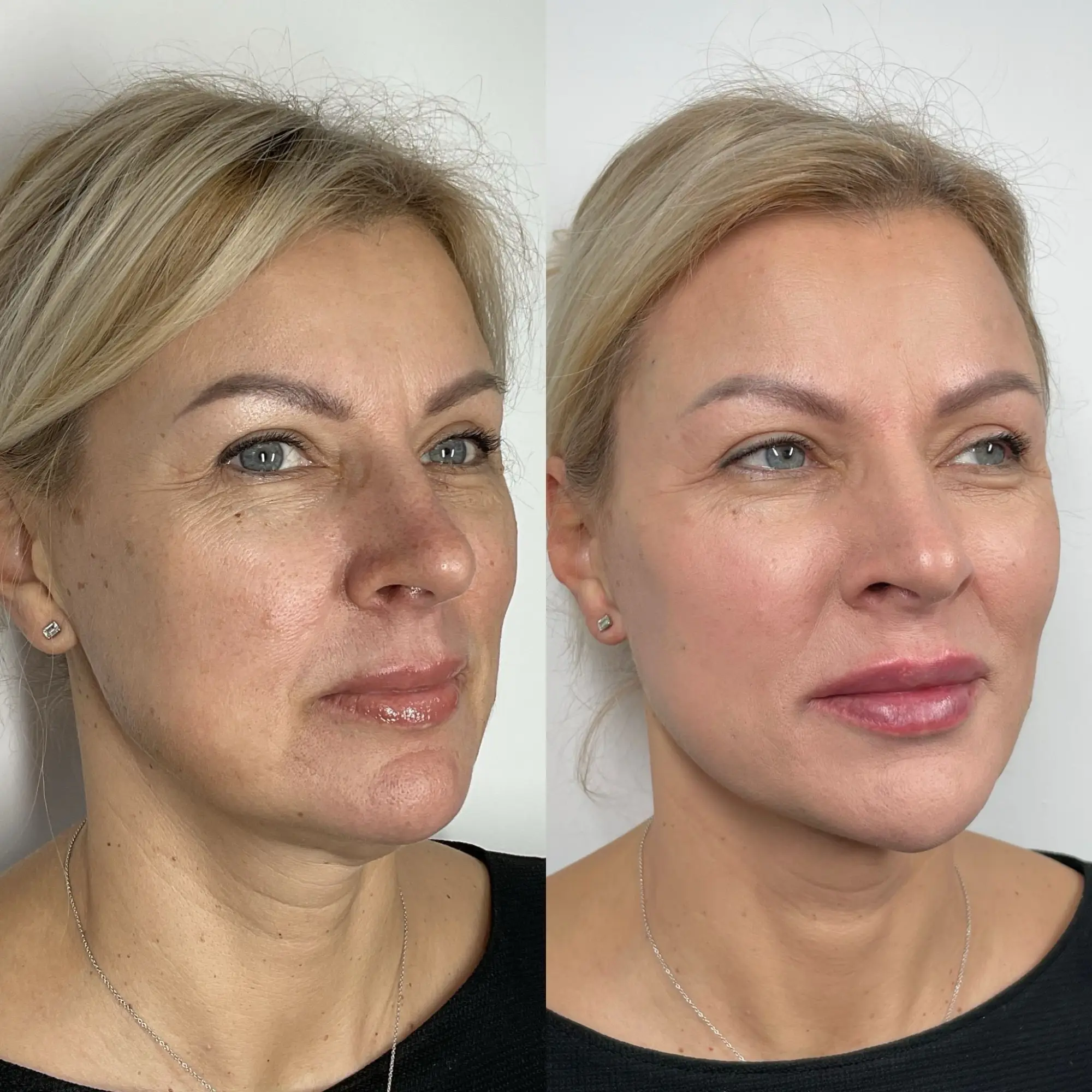 sculptra-before-and-after