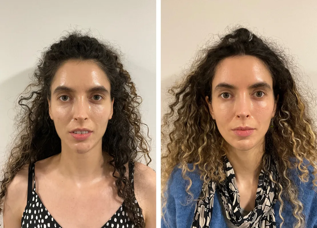 Sculptra Face Treatment in London