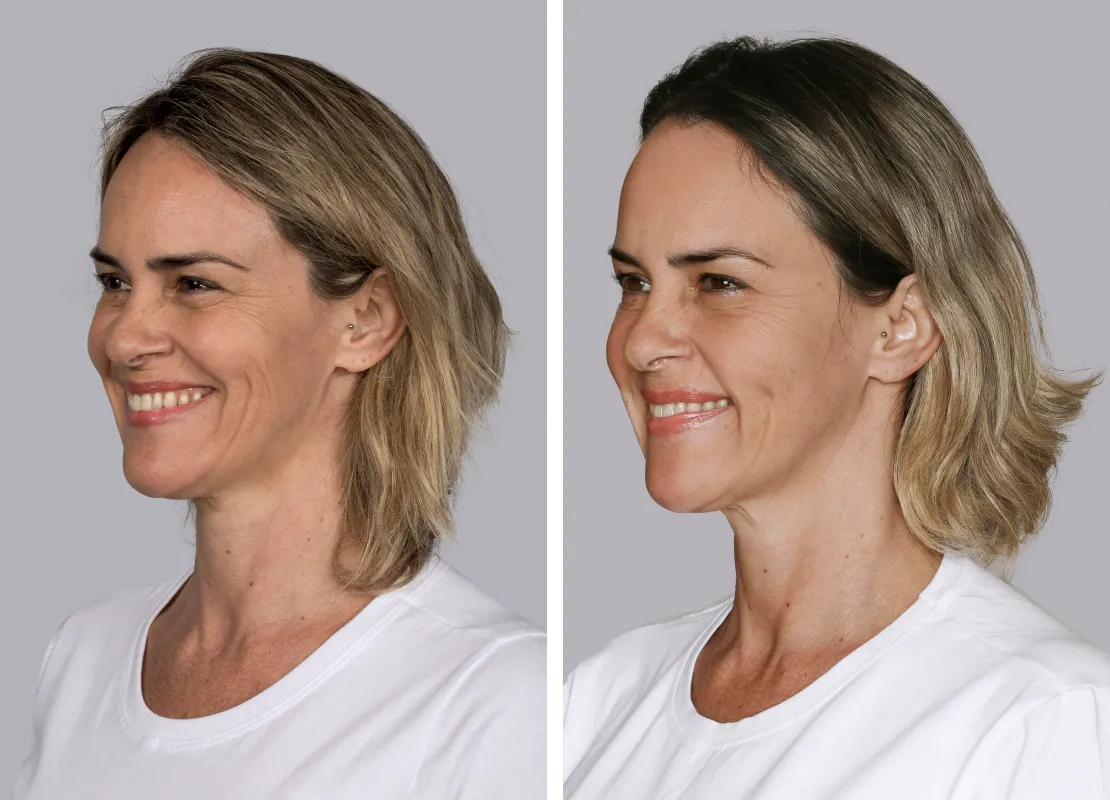 supporting-facial-volume-contour-and-skin-quality