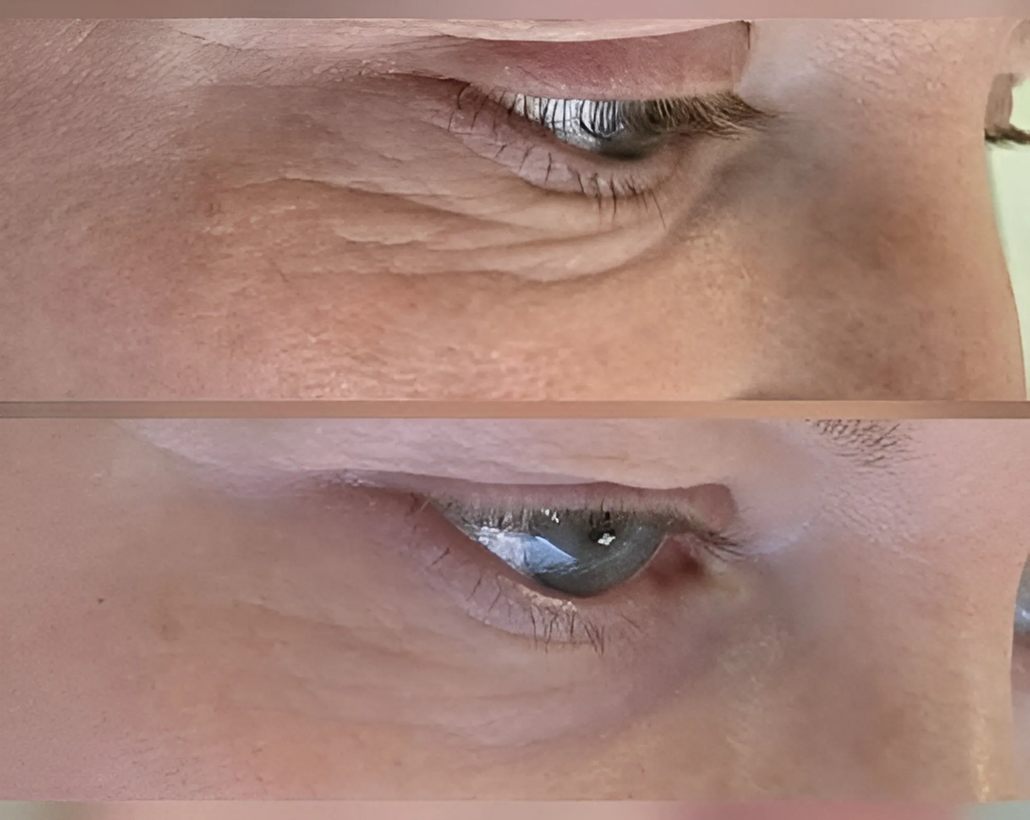 supporting-under-eye-quality-and-soft-tissue-appearance