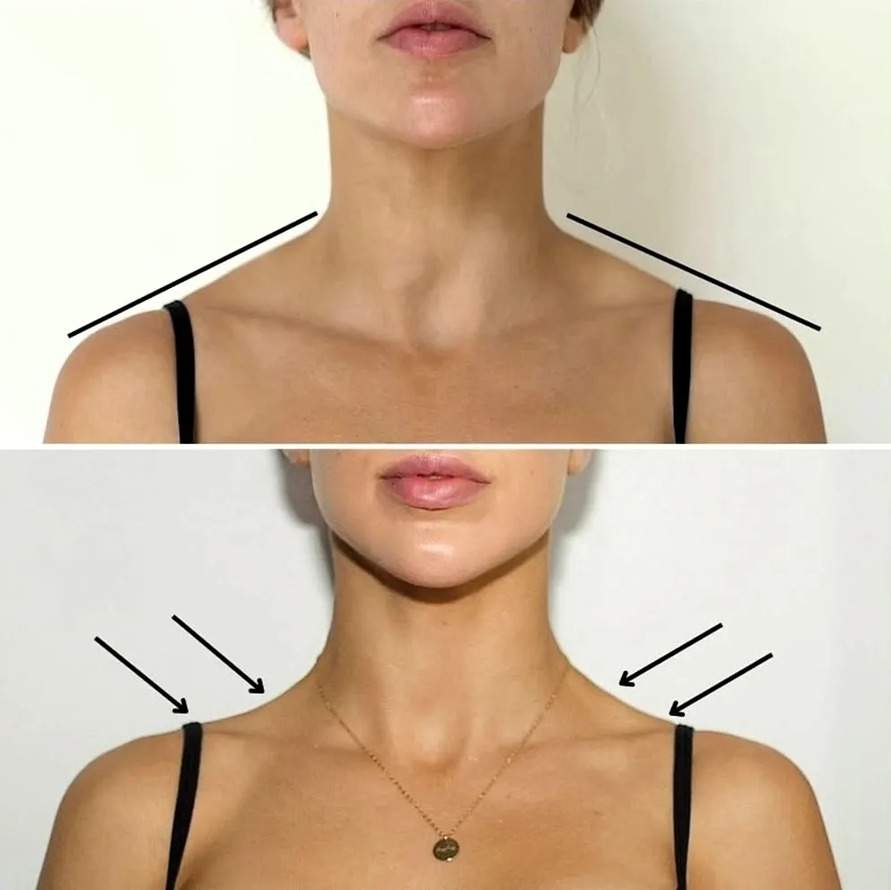 what-barbie-botox
