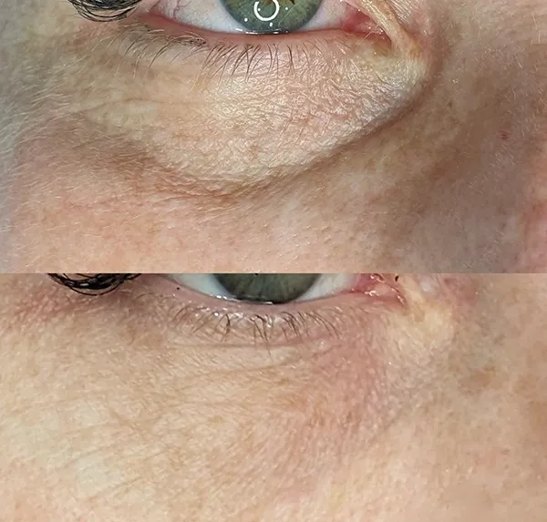 what-nucleofill-eye-treatment