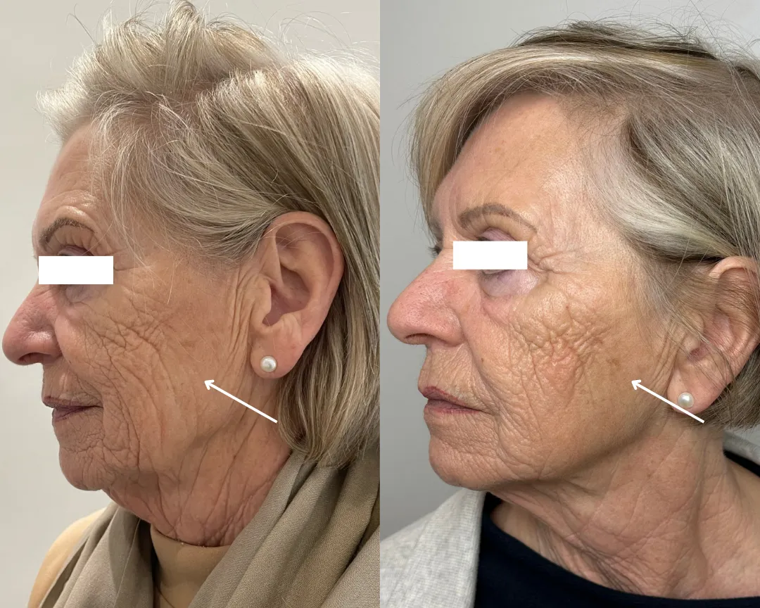 what-sculptra