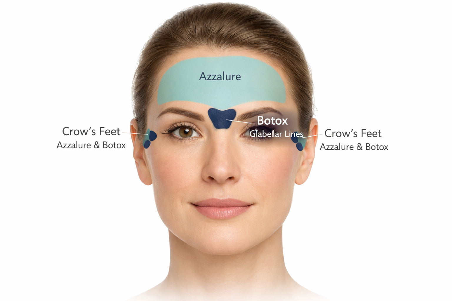 Face diagram showing Azzalure suited to broader areas and Botox suited to precise treatment zones