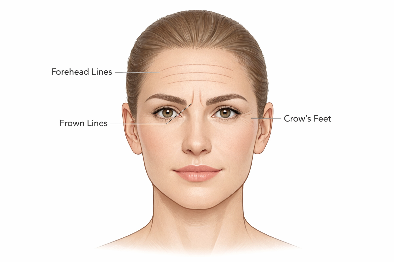 Illustration of face showing forehead lines, frown lines and crow's feet treatment areas
