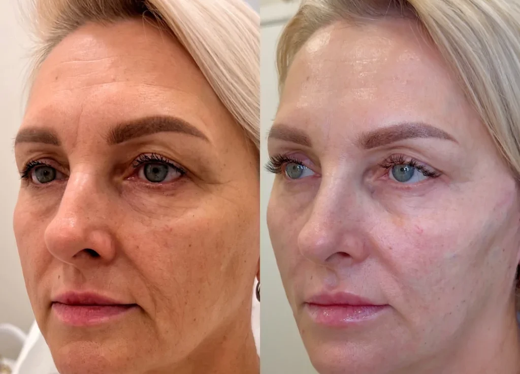 belotero-filler-treatment2
