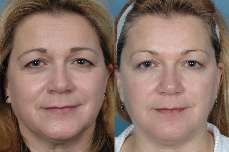 After Belotero filler treatment.