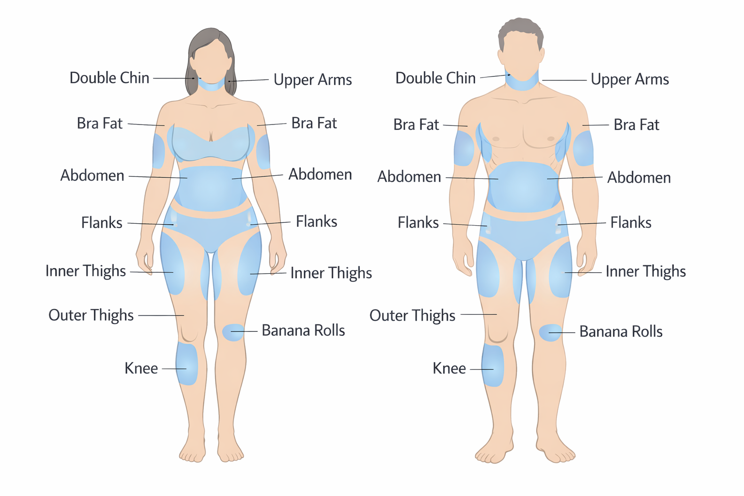 Body diagram showing CoolSculpting treatment areas including abdomen, flanks, thighs and double chin