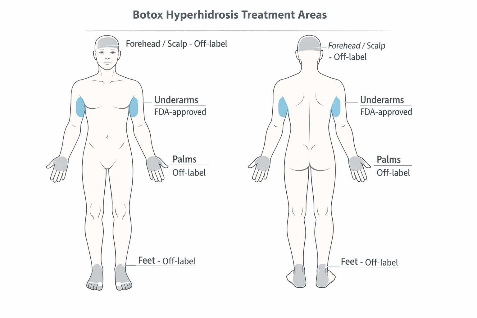 Body diagram showing FDA-approved and off-label Botox treatment areas for hyperhidrosis