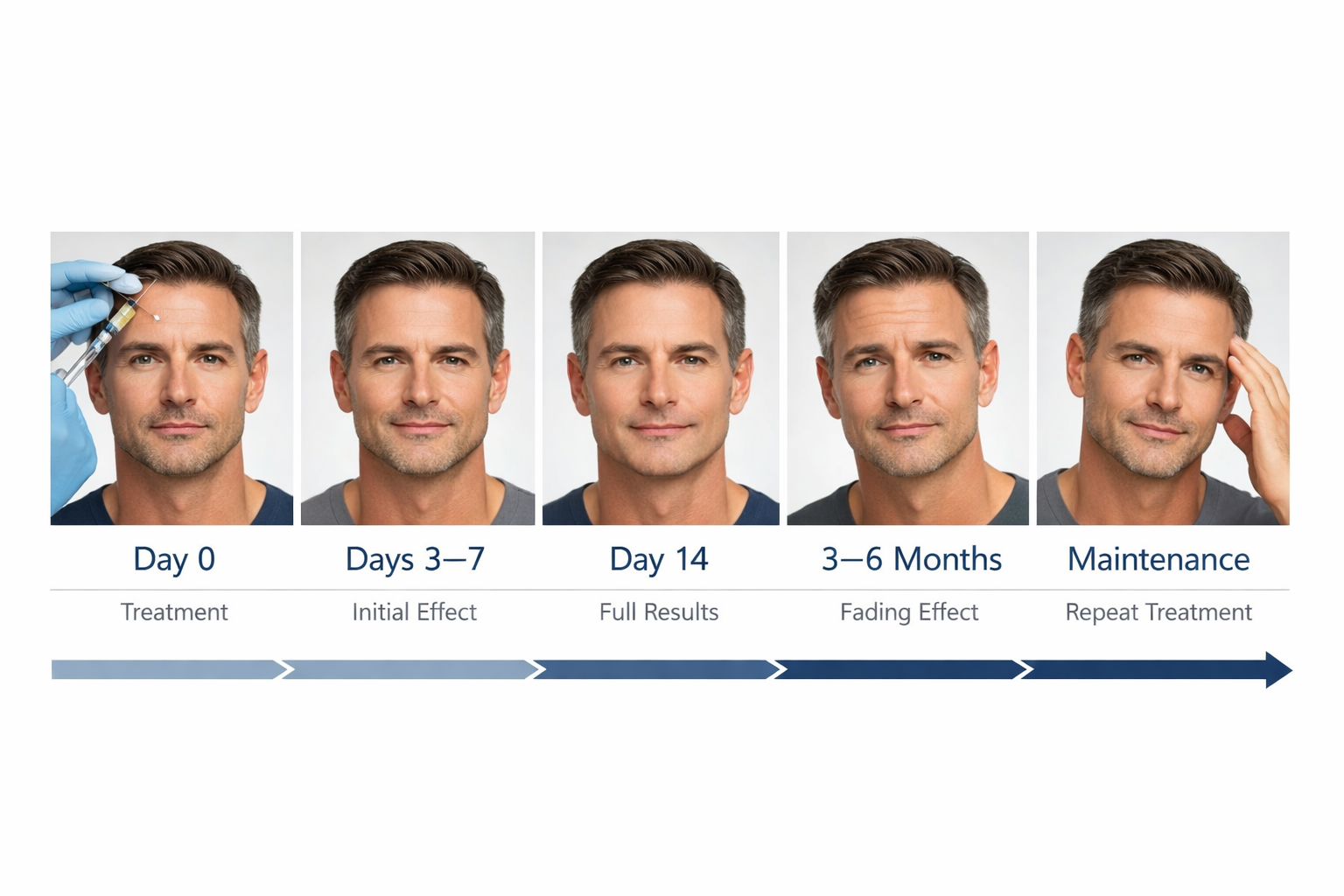 Timeline chart showing when Botox results appear and how long they last for men