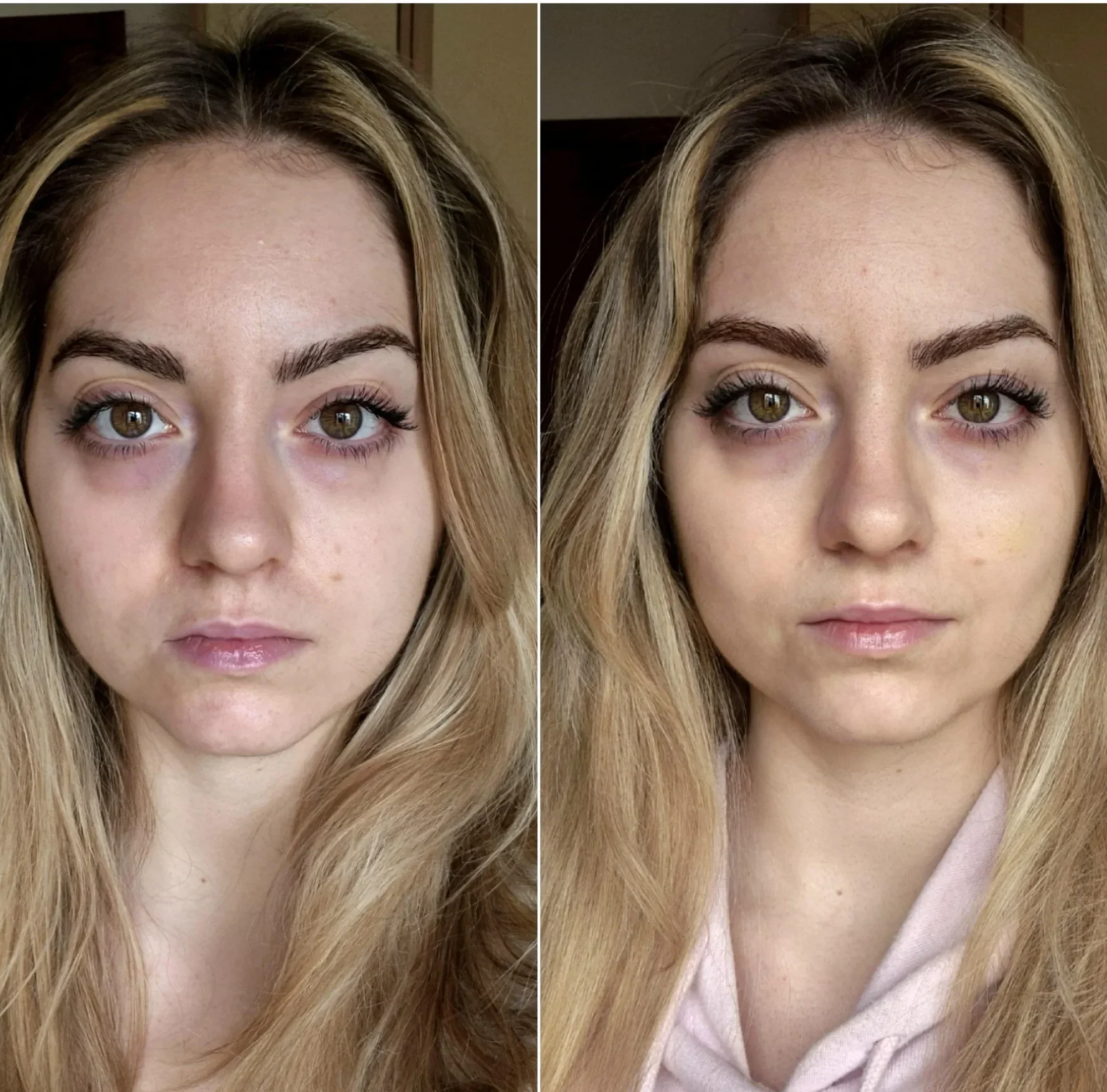 After cheek fiiler.