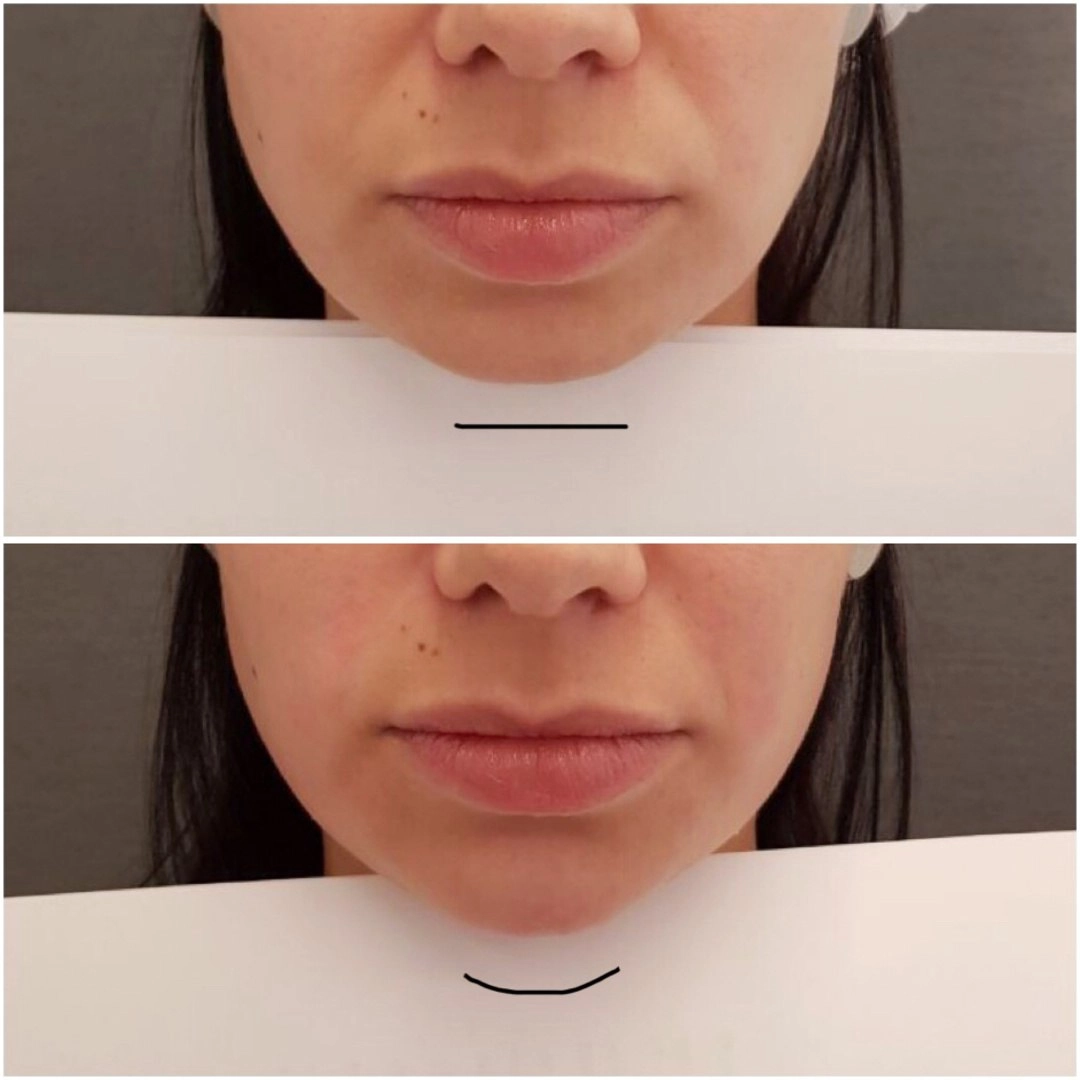 chin-filler-treatment1