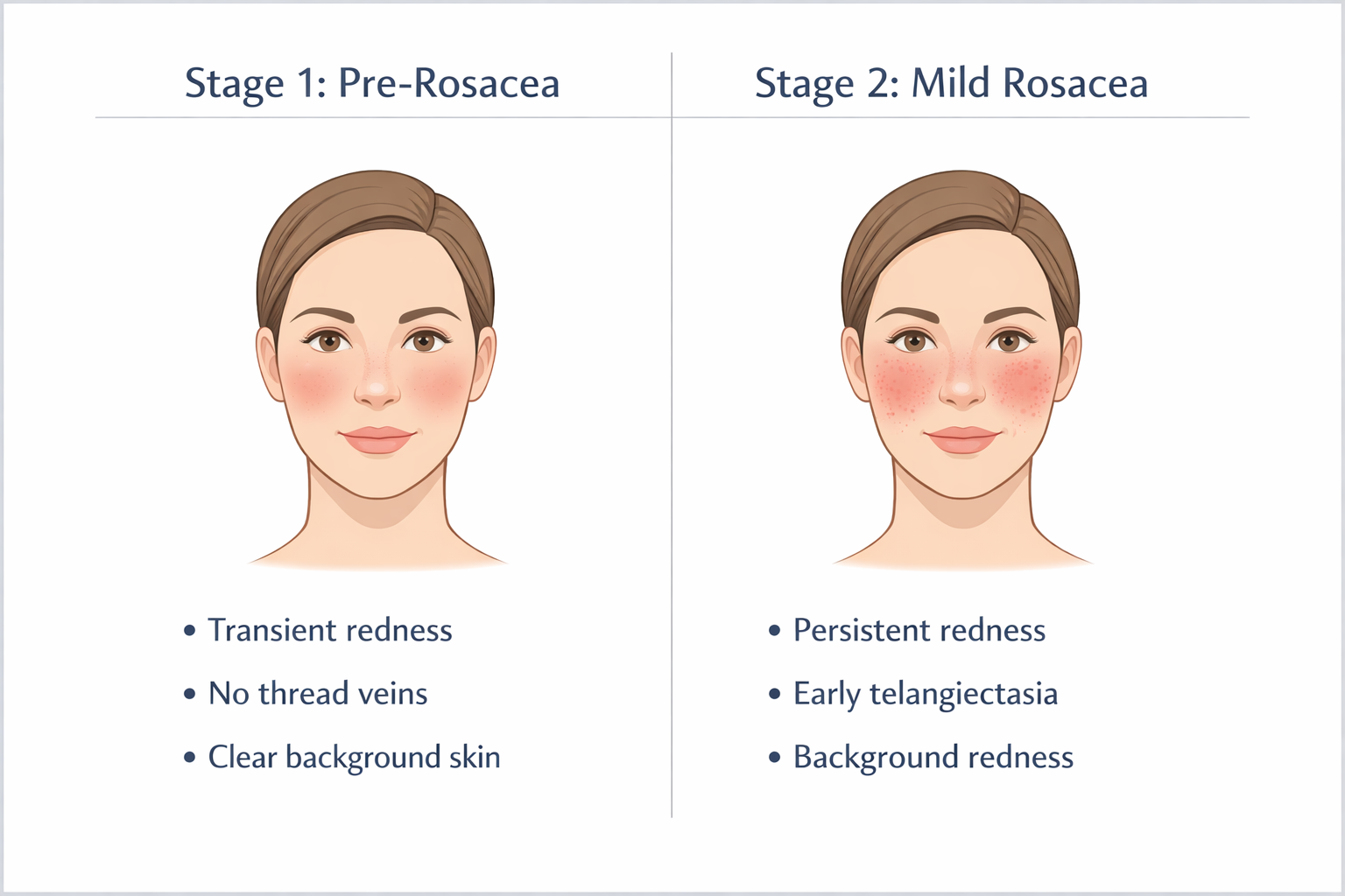 Comparison of pre-rosacea Stage 1 versus mild rosacea Stage 2 showing redness persistence and