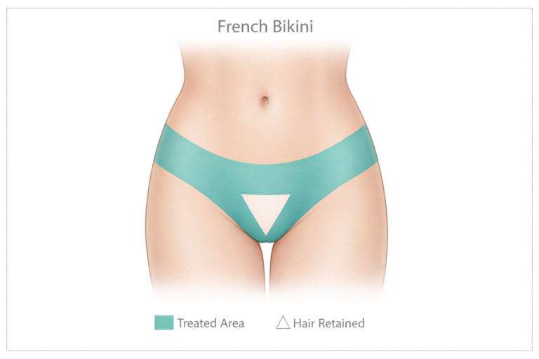 Diagram showing French bikini laser hair removal coverage area on female silhouette