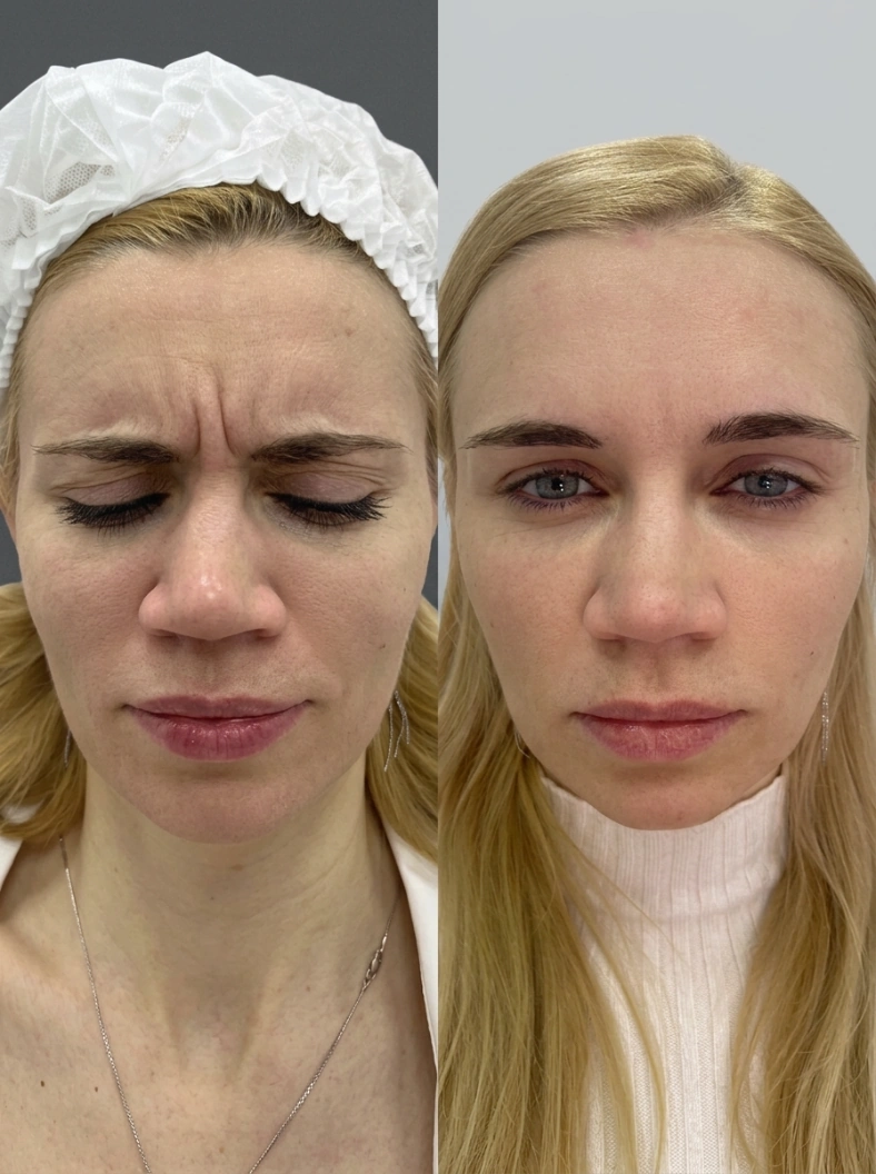 After frown lines botox treatment.