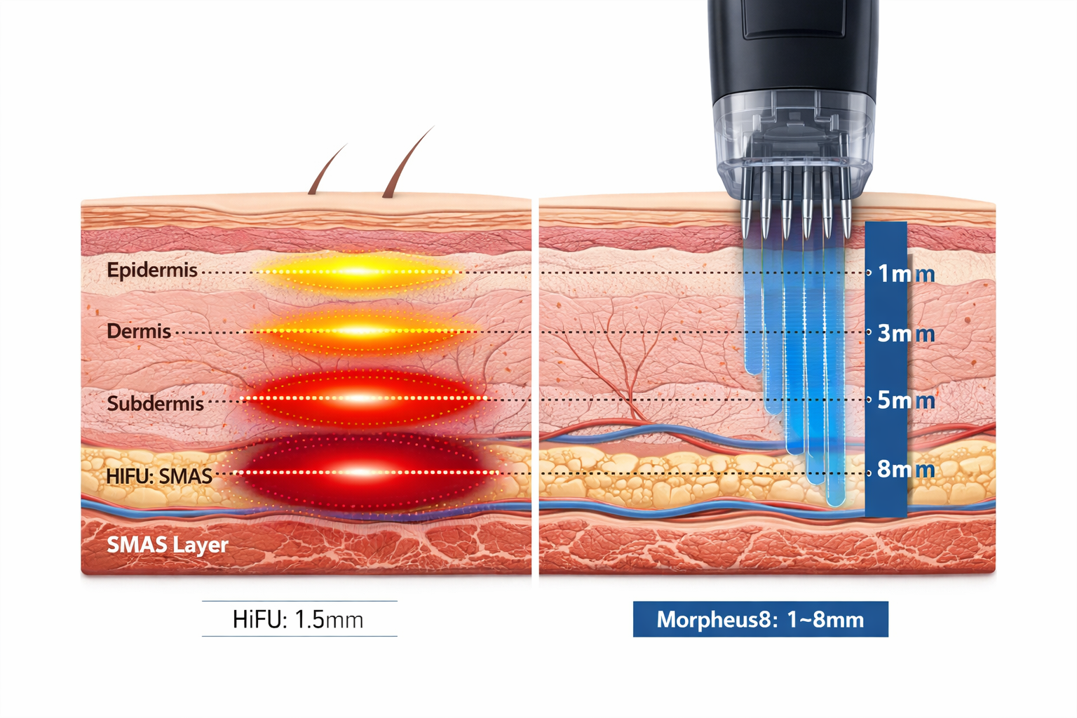 Skin layer diagram comparing HIFU treatment depths and Morpheus8 microneedle depth range
